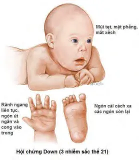 Hội chứng Down